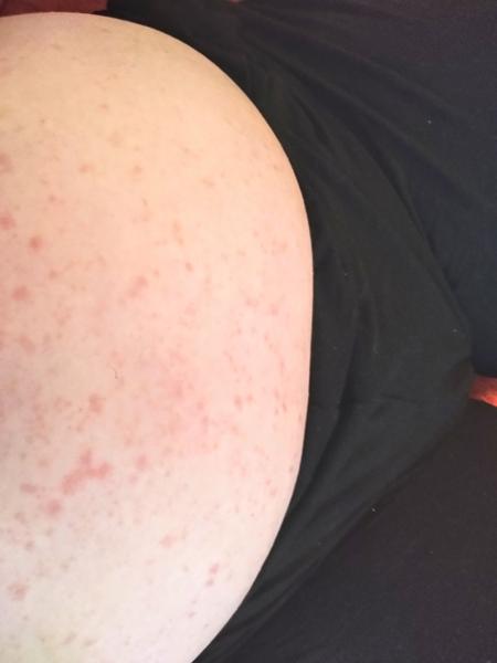 Jak řešit svědivou vyrážku na břiše v těhotenství?