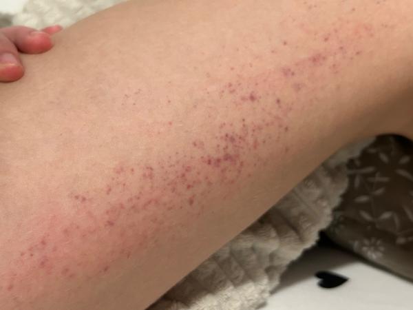 Alergie na potraviny u dětí: Jak poznat reakce?