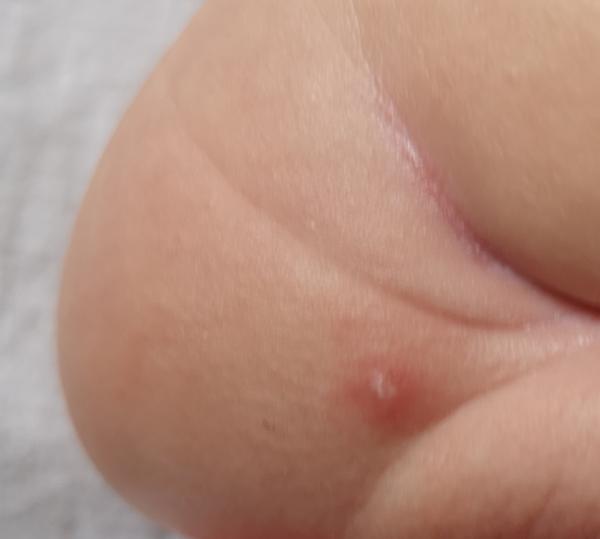 Jeden velký pupínek na zadečku kojence. Co to může být?