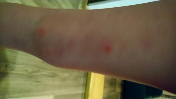 Vyrážka na nohou. Co by to mohlo být? Máme zajít ke kožnímu?