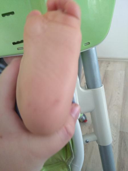 Červené flíčky na patě