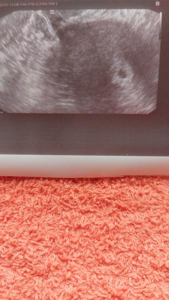 Ultrazvuk v těhotenství. Jaké jsou vaše zkušenosti?