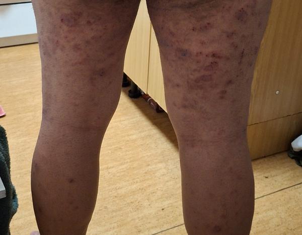 Neznámá kožní onemocnění a jejich obtížná léčba. Máte zkušenost?