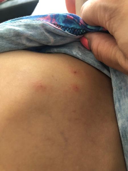 Jak poznat štípance od štěnic a jiného hmyzu?