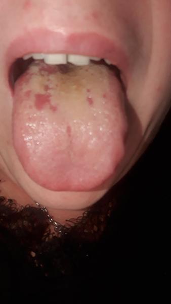 Skvrny na jazyku. Nevíte, co to je?