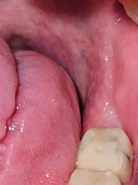 Bolest v dásni po jídle. Co ji způsobuje?