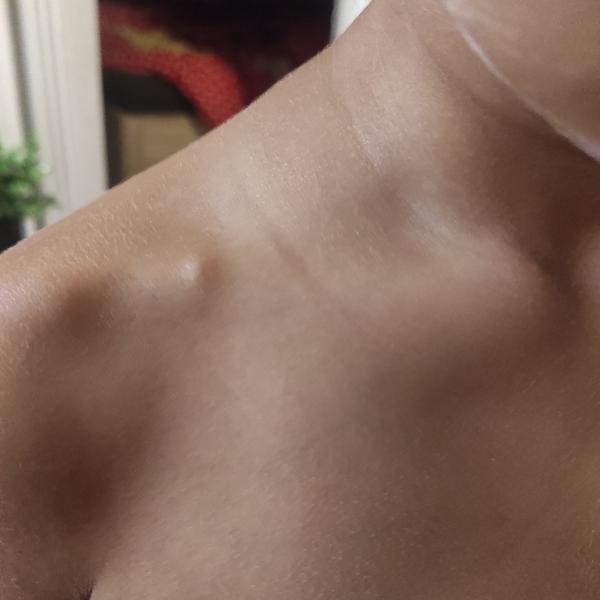 Výrůstek na kosti u dětí. Máte podobné zkušenosti?