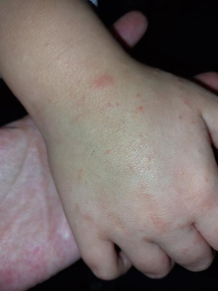 Jak řešit svědivé pupínky na rukou dítěte?