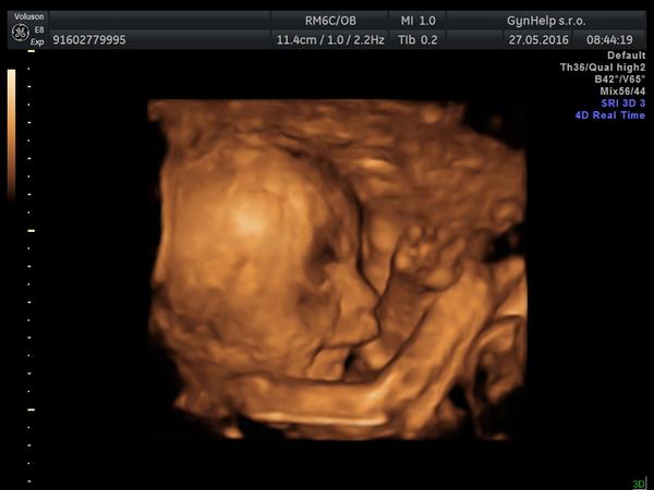 Rozštěp rtu podle 3D ultrazvuku?