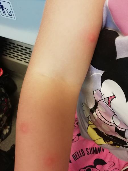 Má moje dcera vyrážku nebo štípanec z dovolené?