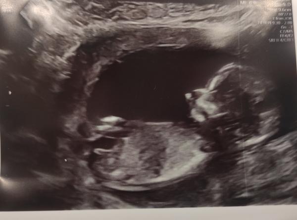 Jak poznat pohlaví dítěte podle pohlavního hrbolku?