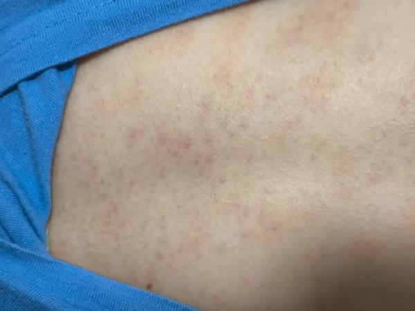 Vyrážka nebo ekzém u dětí. Jak zmírnit?