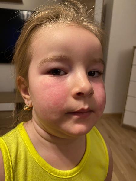 Co dělat, když Fenistil nepomáhá na dětskou vyrážku?