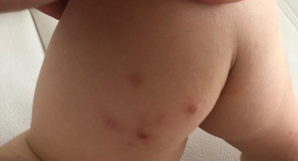 Neštovice nebo jen komáří štípnutí na stehnech?