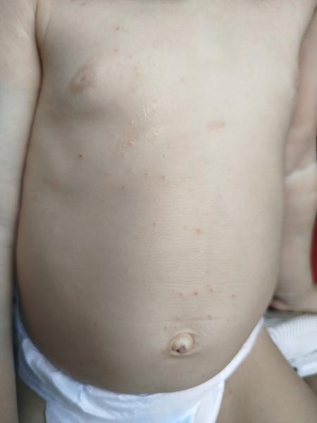 Jak se efektivně zbavit svrabu? Rady pro zoufalé rodiče