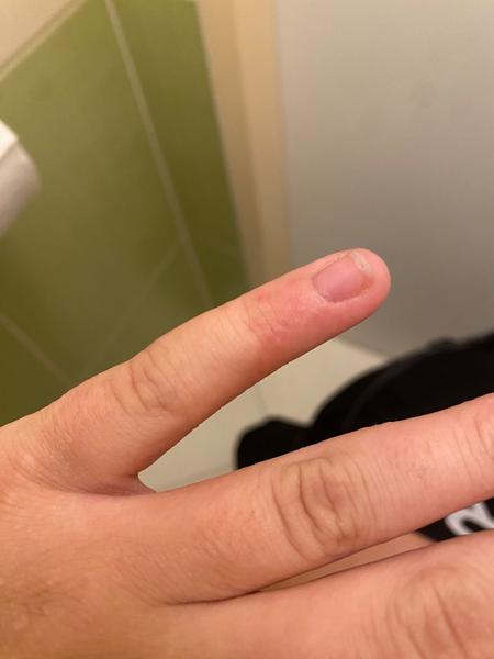 Je to svrab? Jak rozpoznat svrab a co s ním dělat?