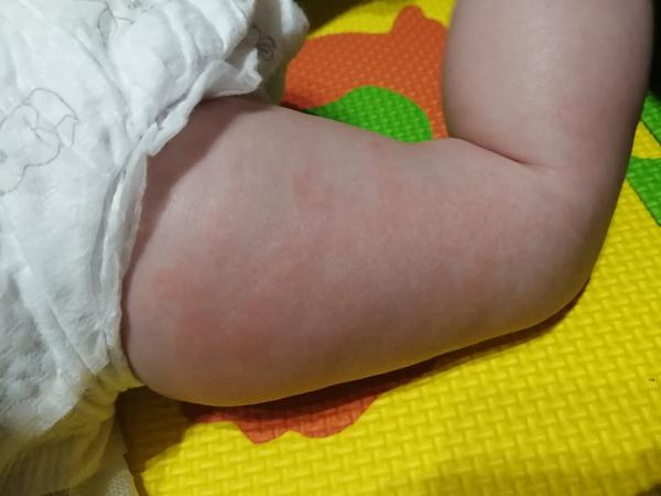 Alergická vyrážka?