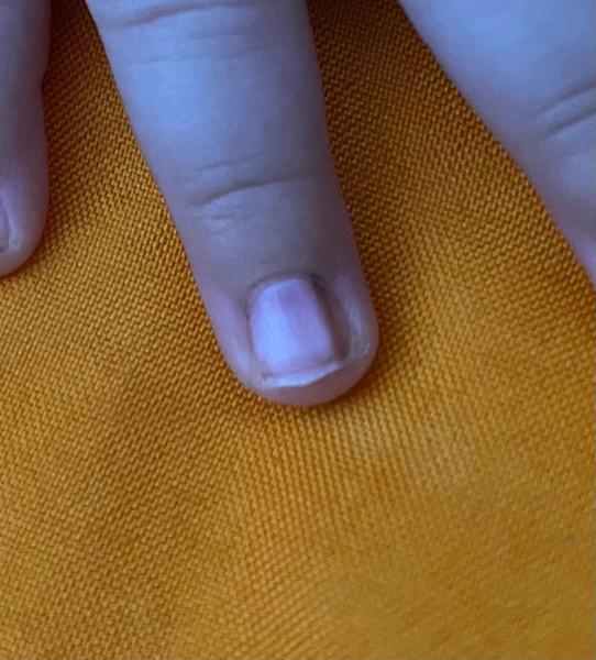 Hnědá čárka na nehtu miminka. Zmizí sama od sebe?