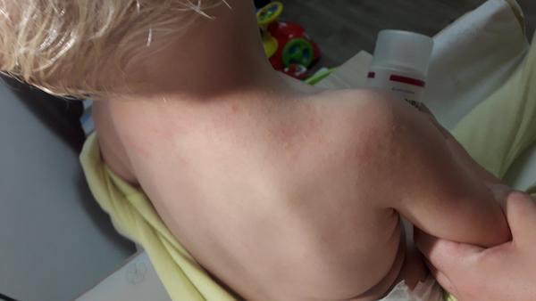 Vyrážka nebo ekzém. Poradíte, prosím, co by to mohlo být?