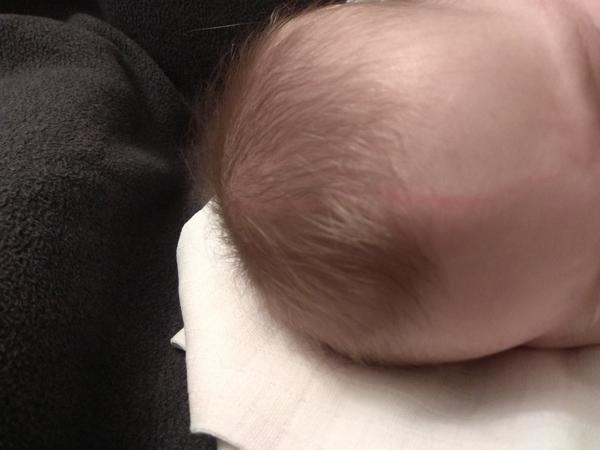 Červená čára na hlavičce kojence