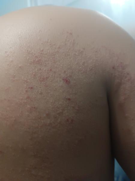 Vyrážka. Máte zkušenost, co by to mohlo být?