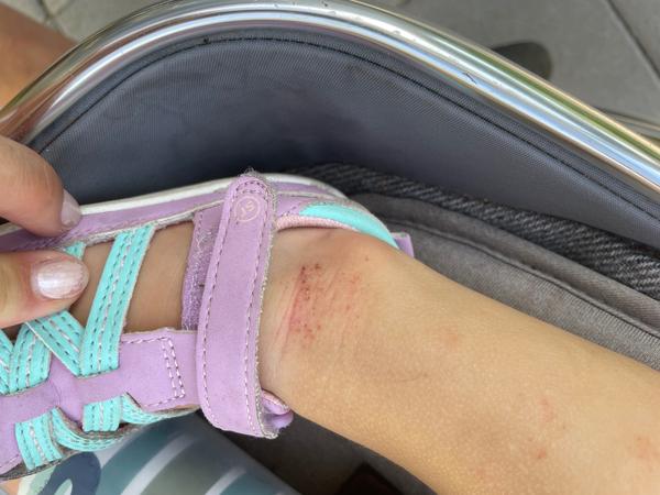 Jak řešit ekzém u 17měsíčního dítěte bez kortikosteroidů?