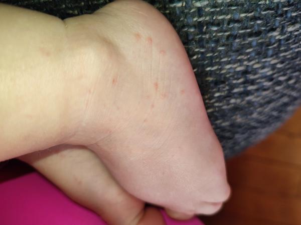 Vyrážka. O co by se mohlo jednat?