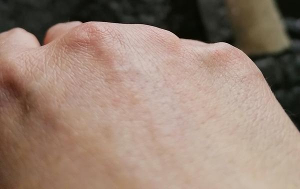 Jak řešit bolest a otok prstu?