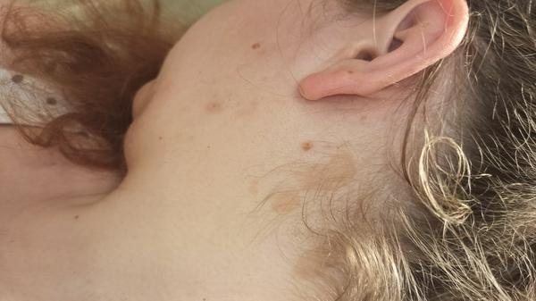 Skvrny za ušima a ve vlasech. O co by se mohlo jednat?