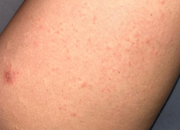 Je to svrab nebo jen obyčejná vyrážka?