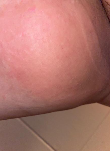 Máte svědivé problémy při menstruaci. Mohlo by jít o svrab?