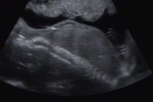 Foto z ultrazvuku 4D/2D 25.tt