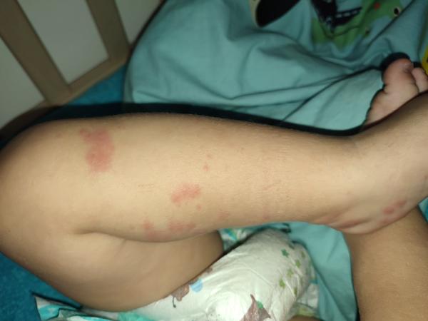 Vyrážka na noze po kontaktu s trávou a jahodami?