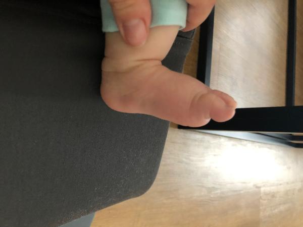 Zatnuté prstíky. Je to normální?