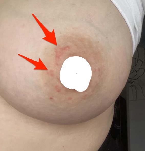 Červený flek a strie na prsu. Je to kojením?