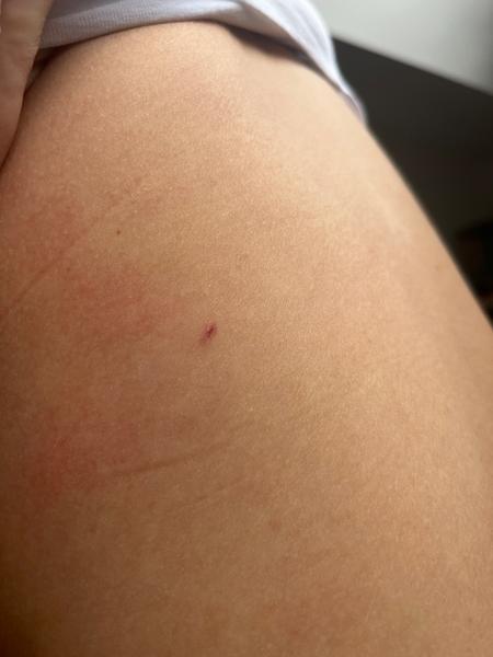 Mám se bát melanomu u drobného škrábance na zádech?