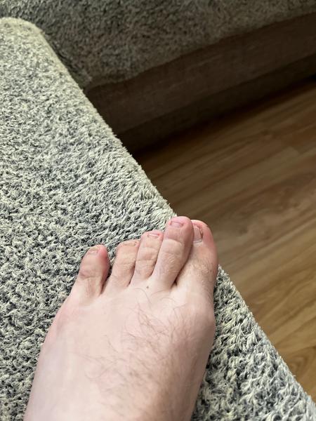 Jak se zbavit bolesti u hallux valgus po operaci?