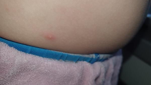 Vyrážka, infekce nebo neštovice. Poradíte, prosím, co by to mohlo být?