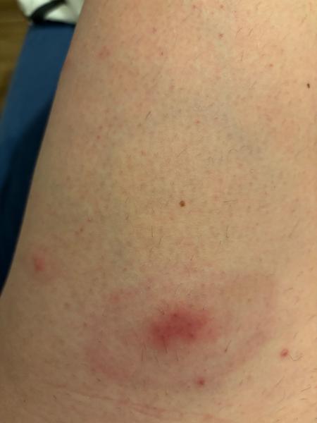 Může se jednat o svrab, nebo je to něco jiného?