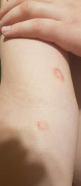 Jak rozpoznat vyrážku u dítěte? Pomoc rodičům.