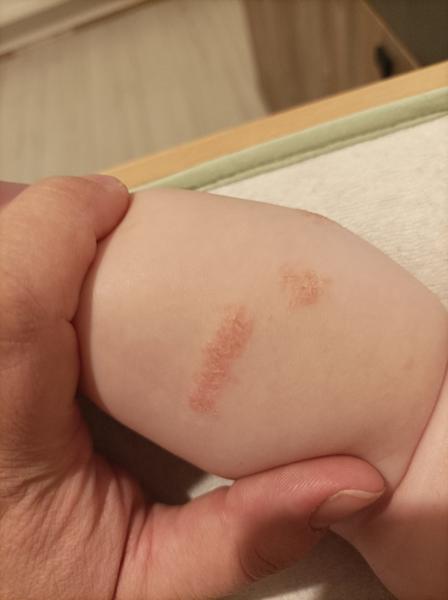 Ekzém, nebo něco jiného?