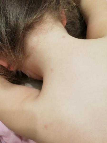 Vyrážka s puchýřky po covidu. Neštovice nebo jiný příznak?