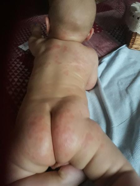 Co je to za vyrážku?