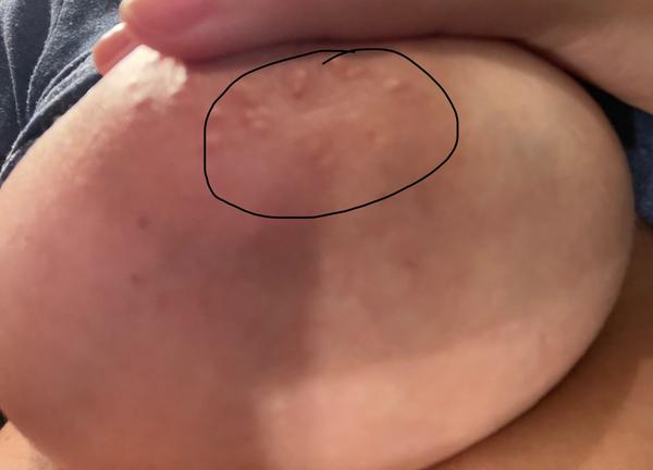 Drobná vráska na prsu. Může to být problém?