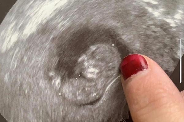 Prosáknuté záhlaví ve 12 tt. Může jít o vrozenou vývojovou vadu plodu?