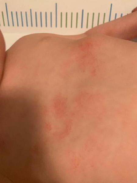 Atopický ekzém u dětí. Objevuje se a mizí. Typická místa pro ekzém jsou ale vždy čistá.