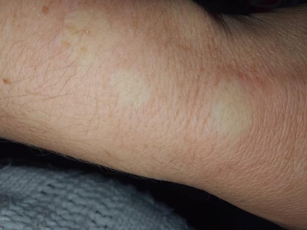 Neznámé štípance: Jaké jsou vaše zkušenosti a doporučení?