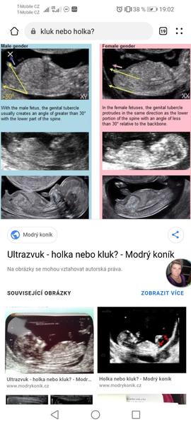 Odhad pohlaví miminka podle fotek ve 12. týdnu těhotenství