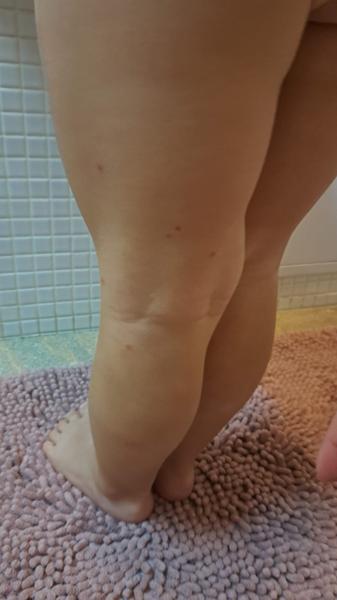 Co způsobuje vyrážku na noze syna?