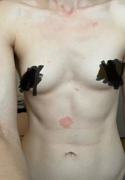 Vystouplá vyrážka: Atopická dermatitida nebo kandida?